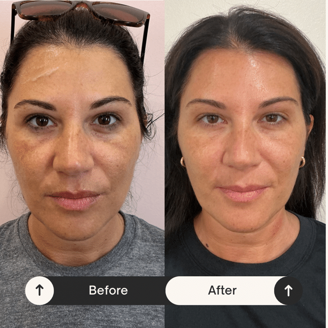 Before and After Image: Facial with PDGF/PRP - front