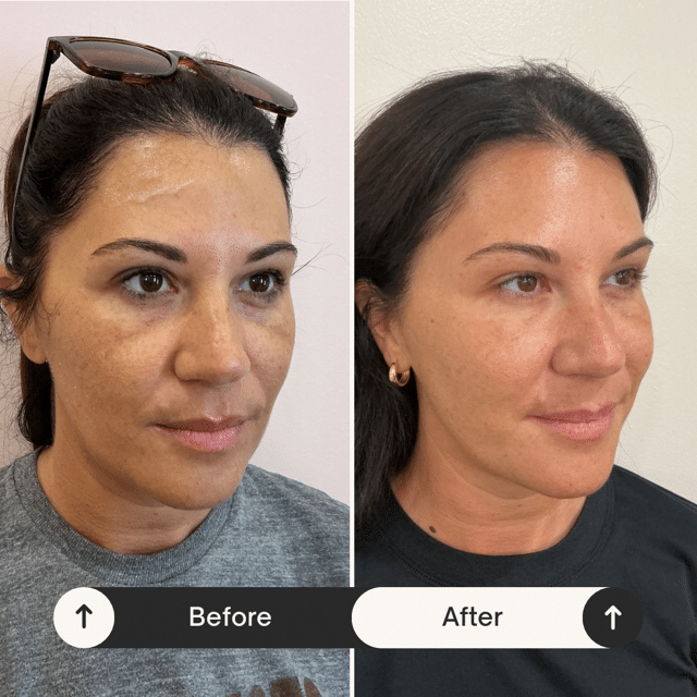 Before and After Image: Facial with PDGF/PRP - right-front-oblique