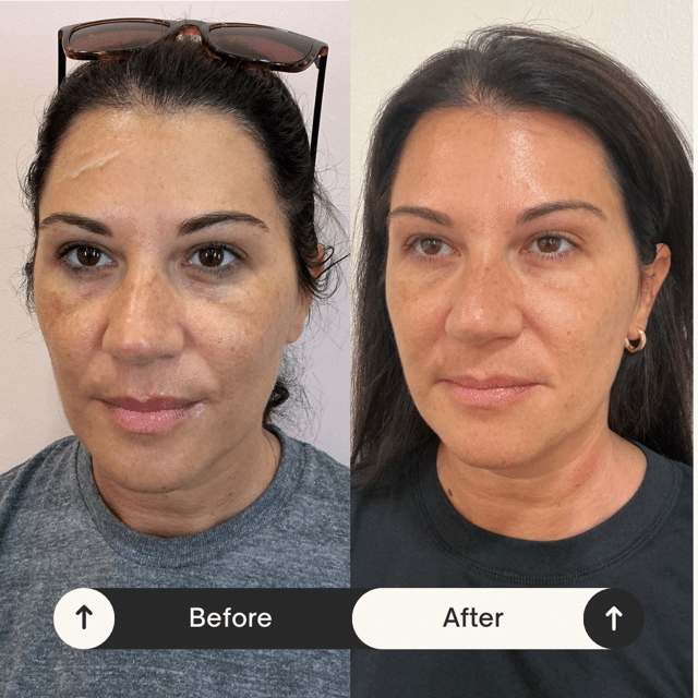 Before and After Image: Facial with PDGF/PRP - left-front-oblique