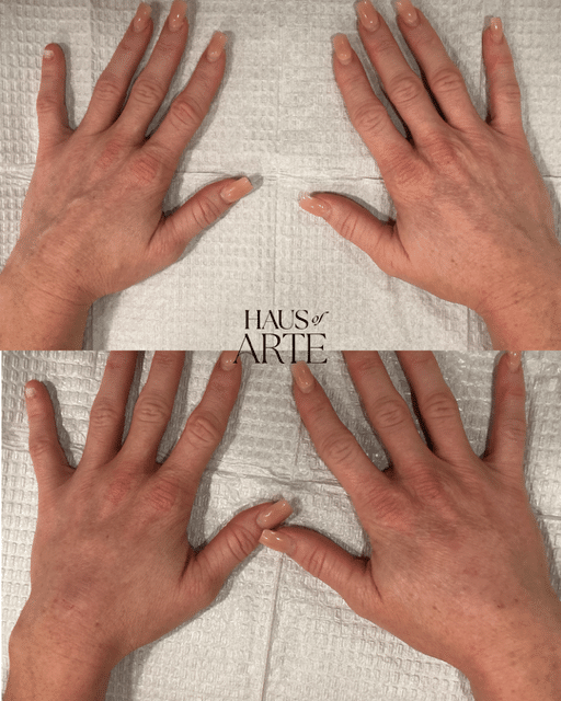 Before and After Image: Body Contouring - front
