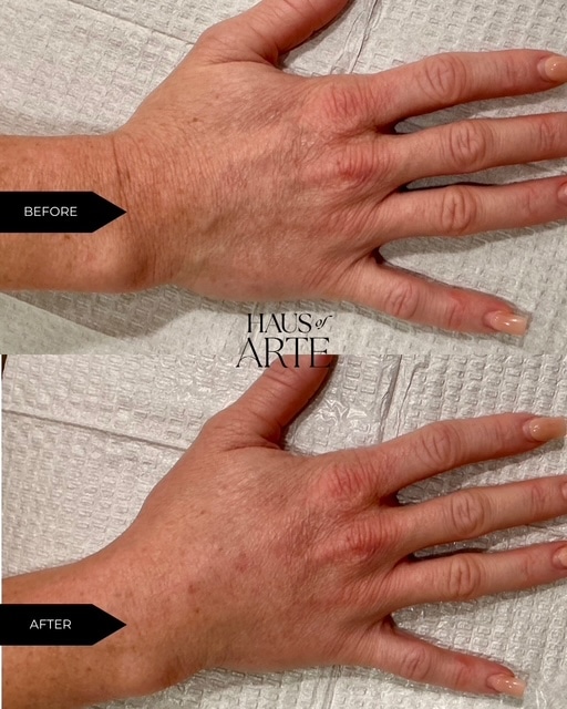 Before and After Image: Body Contouring - front