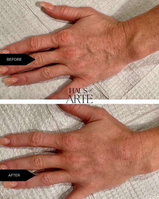 Before and After Image: Body Contouring - front
