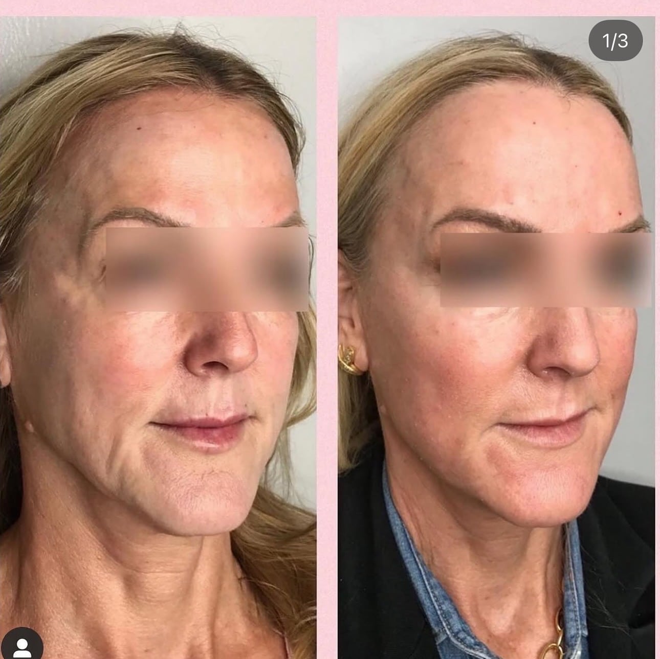 Before and After Image: Filler - right-front-oblique
