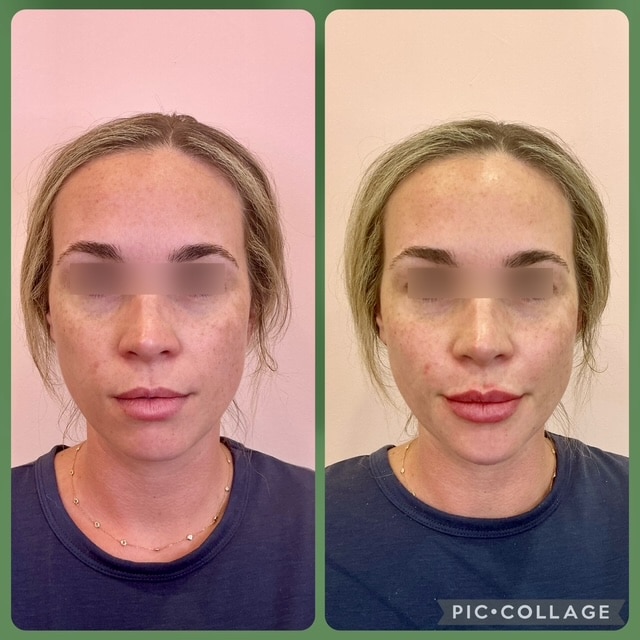 Before and After Image: Filler - front