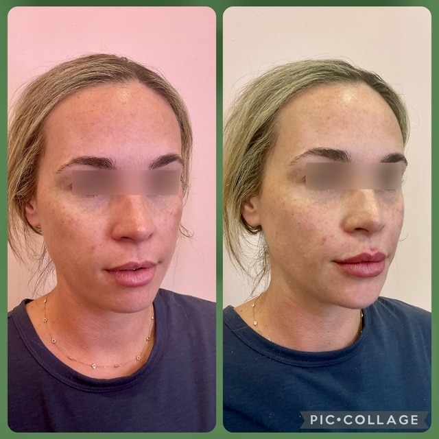 Before and After Image: Filler - right-front-oblique