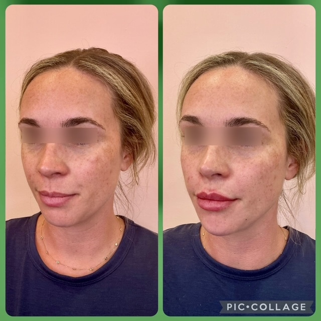 Before and After Image: Filler - left-front-oblique