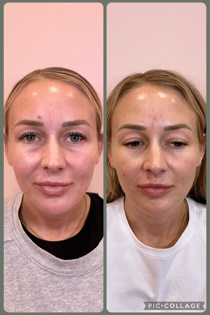 Before and After Image: Filler - front