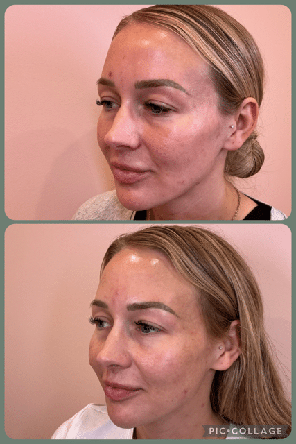 Before and After Image: Filler - left-front-oblique