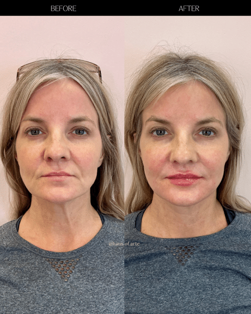 Before and After Image: Filler - front