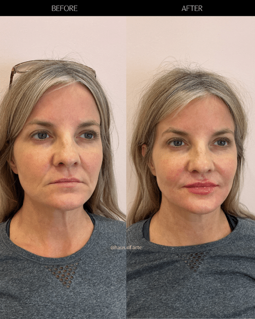 Before and After Image: Filler - right-front-oblique