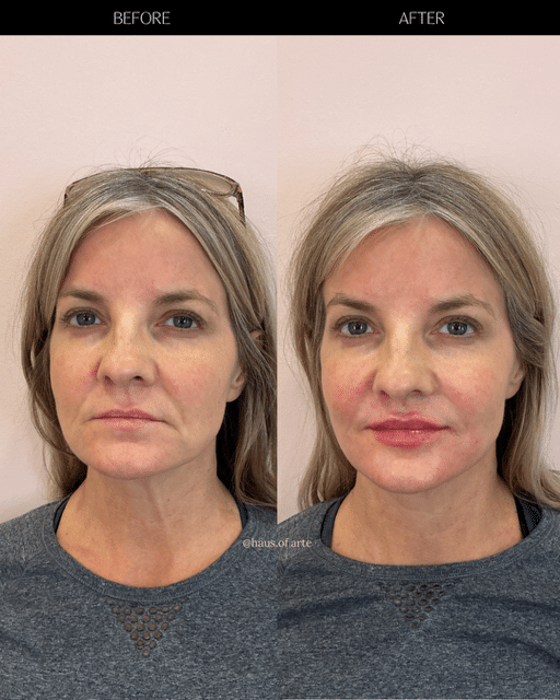 Before and After Image: Filler - left-front-oblique
