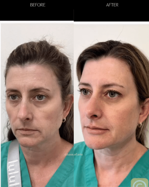 Before and After Image: Filler - left-front-oblique
