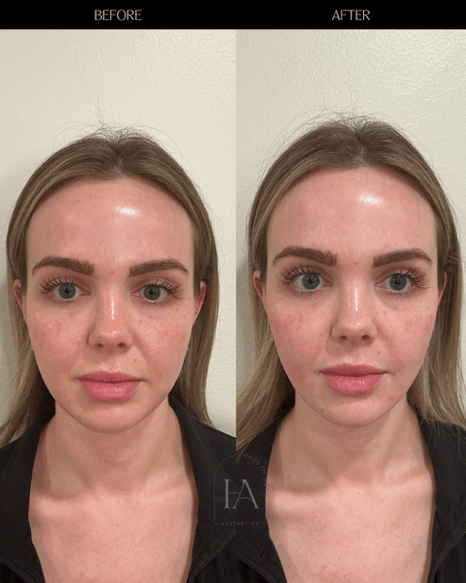 Before and After Image: Filler - front