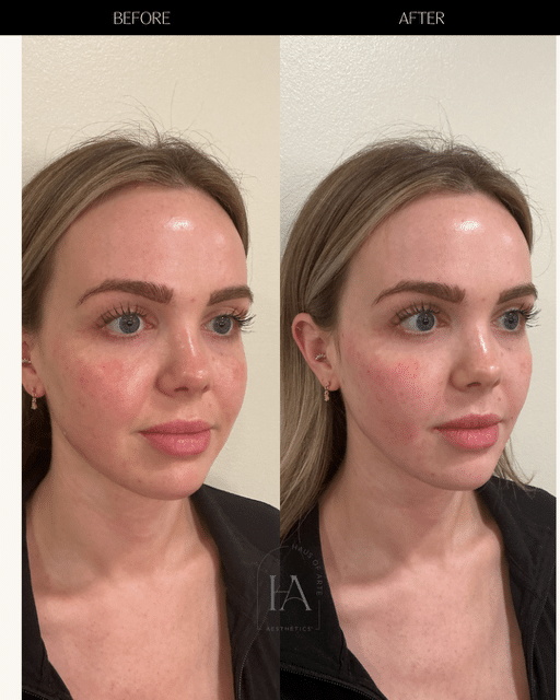 Before and After Image: Filler - right-front-oblique
