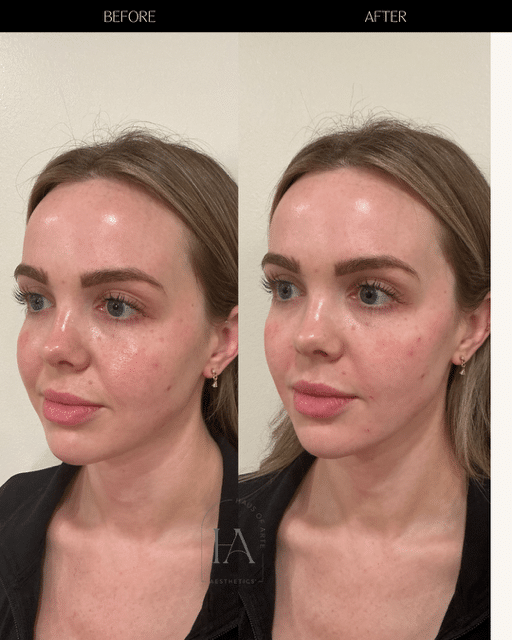 Before and After Image: Filler - left-front-oblique