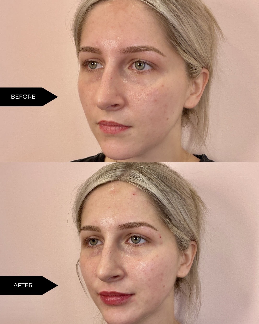 Before and After Image: Filler - left-front-oblique