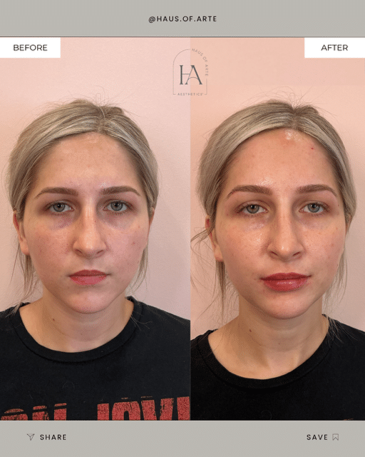 Before and After Image: Filler - front