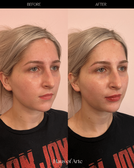 Before and After Image: Filler - right-front-oblique