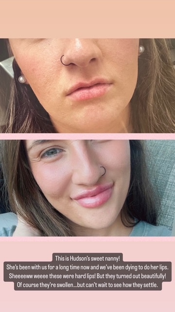 Before and After Image: Filler - right-front-oblique