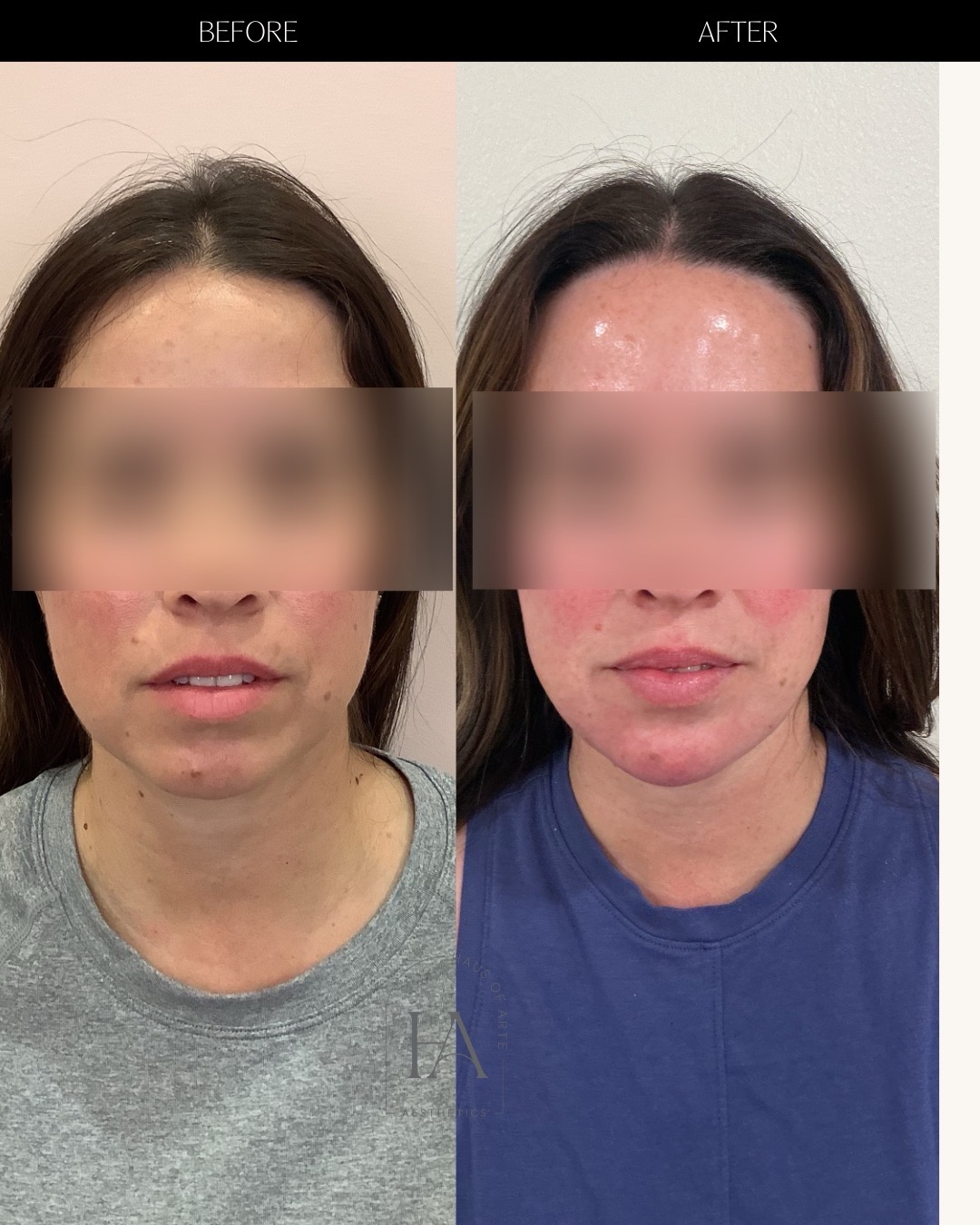 Before and After Image: Filler - front