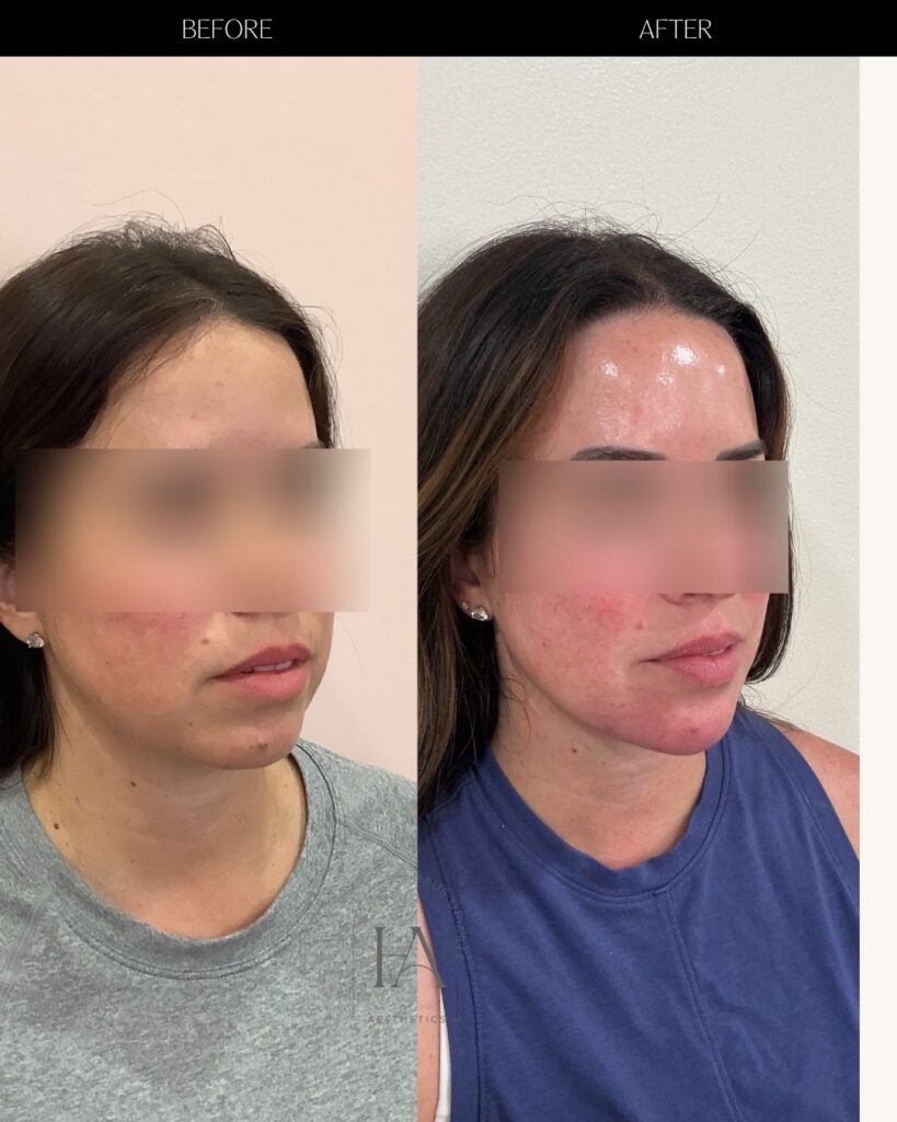 Before and After Image: Filler - right-front-oblique
