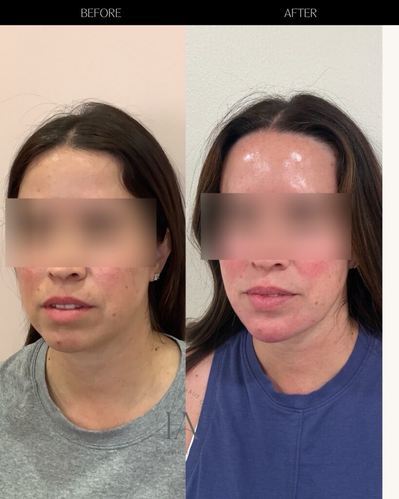 Before and After Image: Filler - left-front-oblique