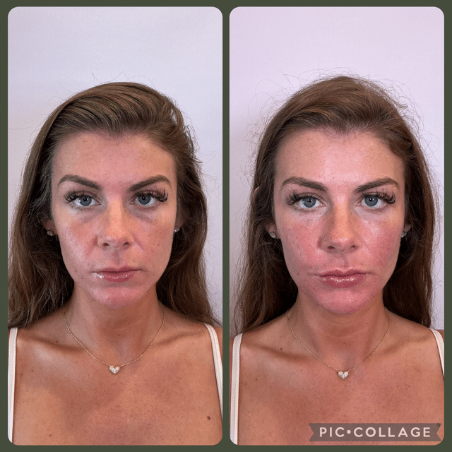 Before and After Image: Filler - front