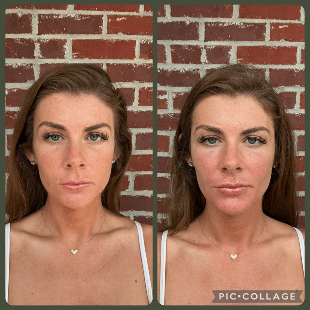 Before and After Image: Filler - front