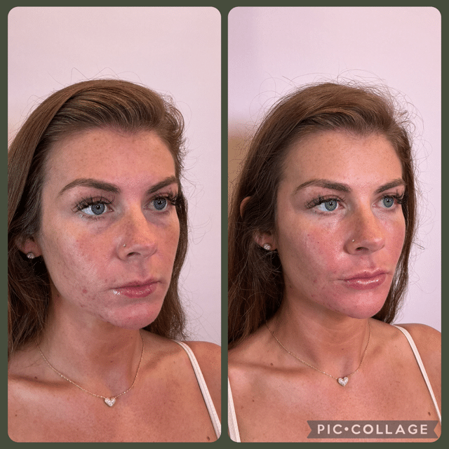 Before and After Image: Filler - right-front-oblique