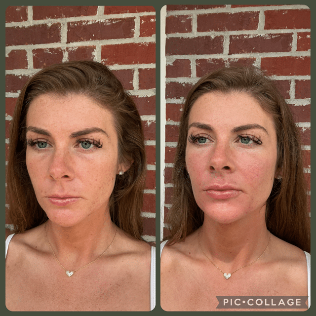 Before and After Image: Filler - left-front-oblique