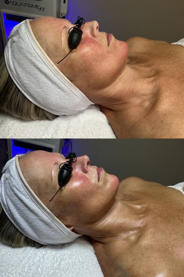 Before and After Image: Post Deluxe Aquafirme and FactorFive Peel - front