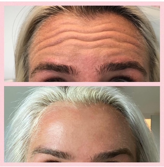 Before and After Image: Tox - front