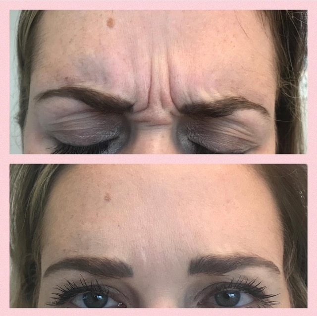 Before and After Image: Tox - front