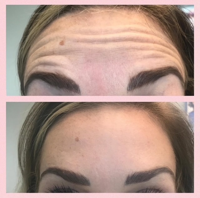 Before and After Image: Tox - front