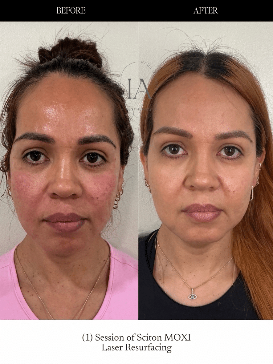 Before and After Image: MOXI Laser - front