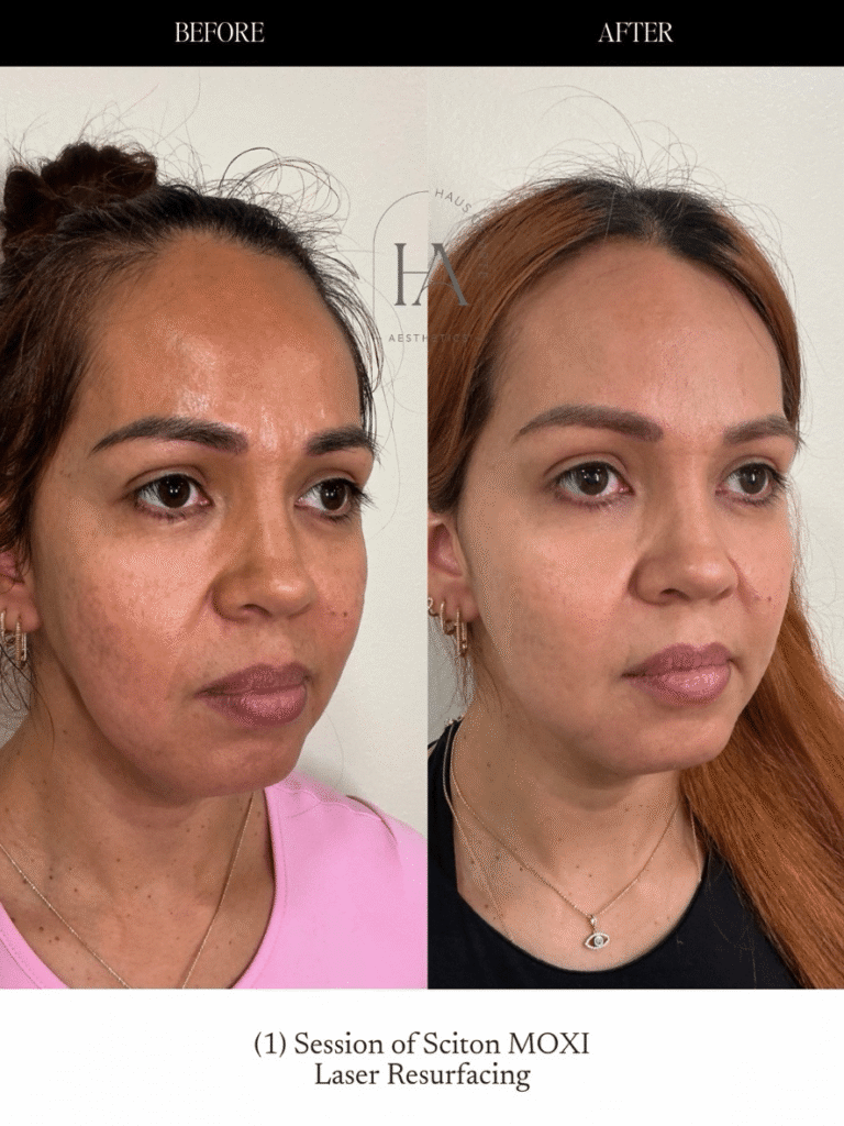 Before and After Image: MOXI Laser - right-front-oblique