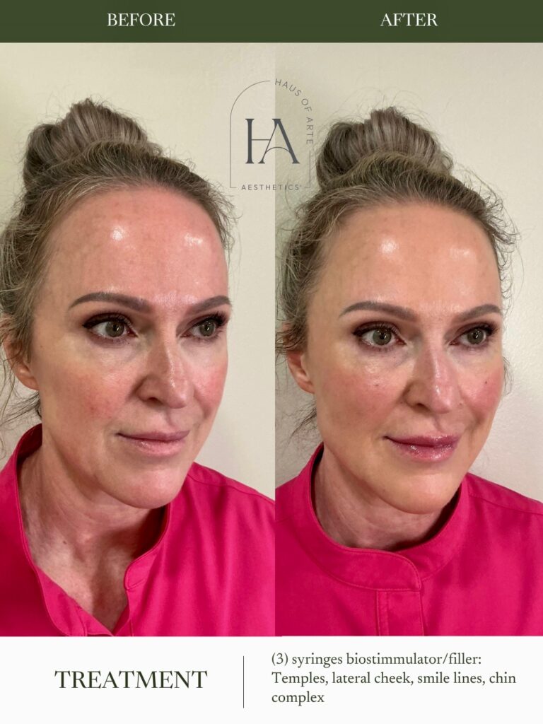 Before and After Image: 3 Syringes Biostimmulator/filler: Temples, lateral cheek, smile line, chin complex - right-front-oblique