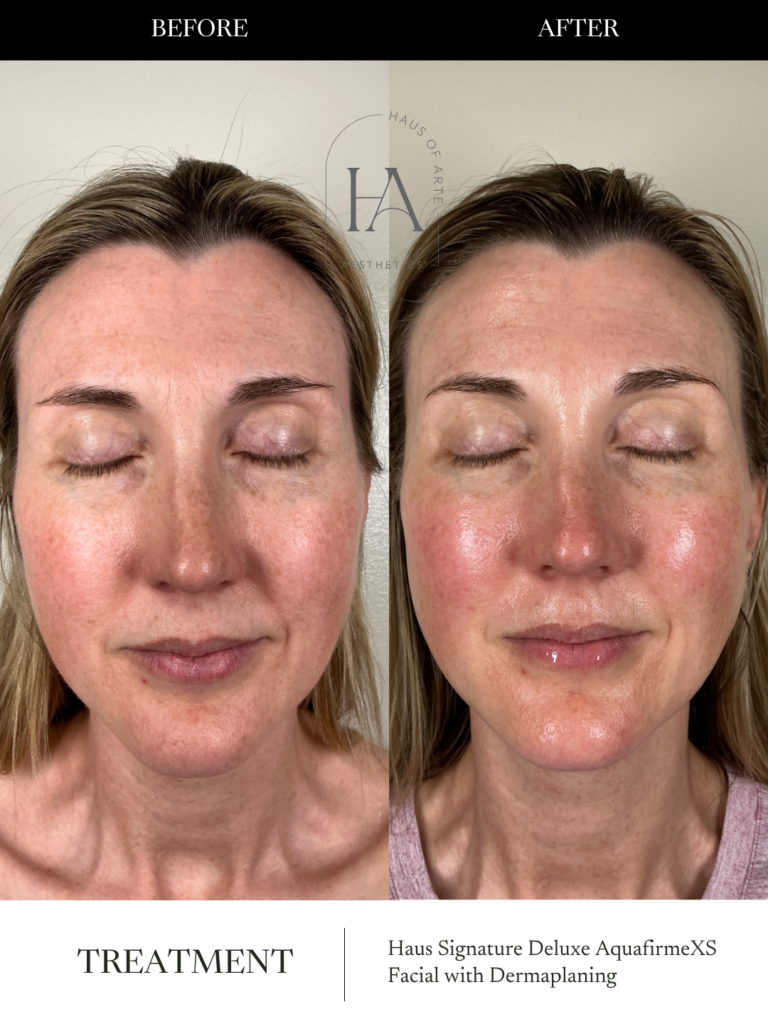 Before and After Image: Haus Signature Deluxe AquafirmeXS Facial with Dermaplaning - front