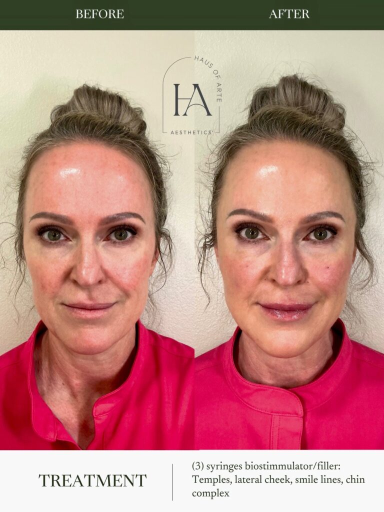 Before and After Image: 3 Syringes Biostimmulator/filler: Temples, lateral cheek, smile line, chin complex - front