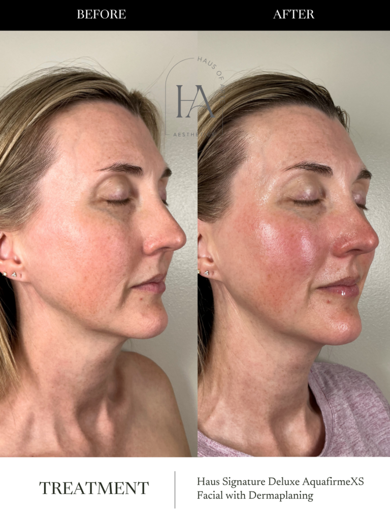 Before and After Image: Haus Signature Deluxe AquafirmeXS Facial with Dermaplaning - right-front-oblique