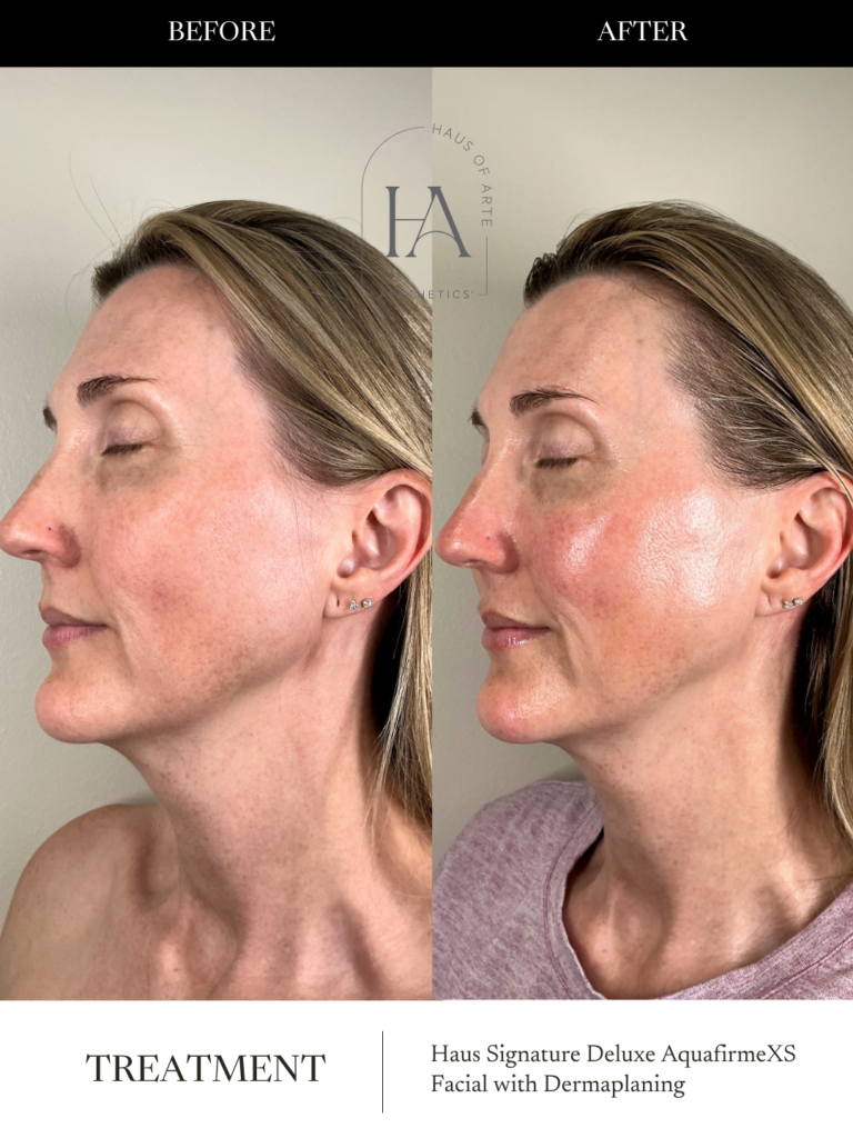 Before and After Image: Haus Signature Deluxe AquafirmeXS Facial with Dermaplaning - left-side