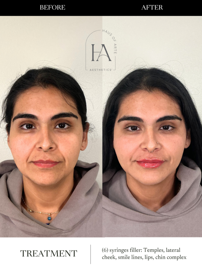 Before and After Image: 6 Syringes filler: Temples, lateral cheek, smile line, chin complex - front