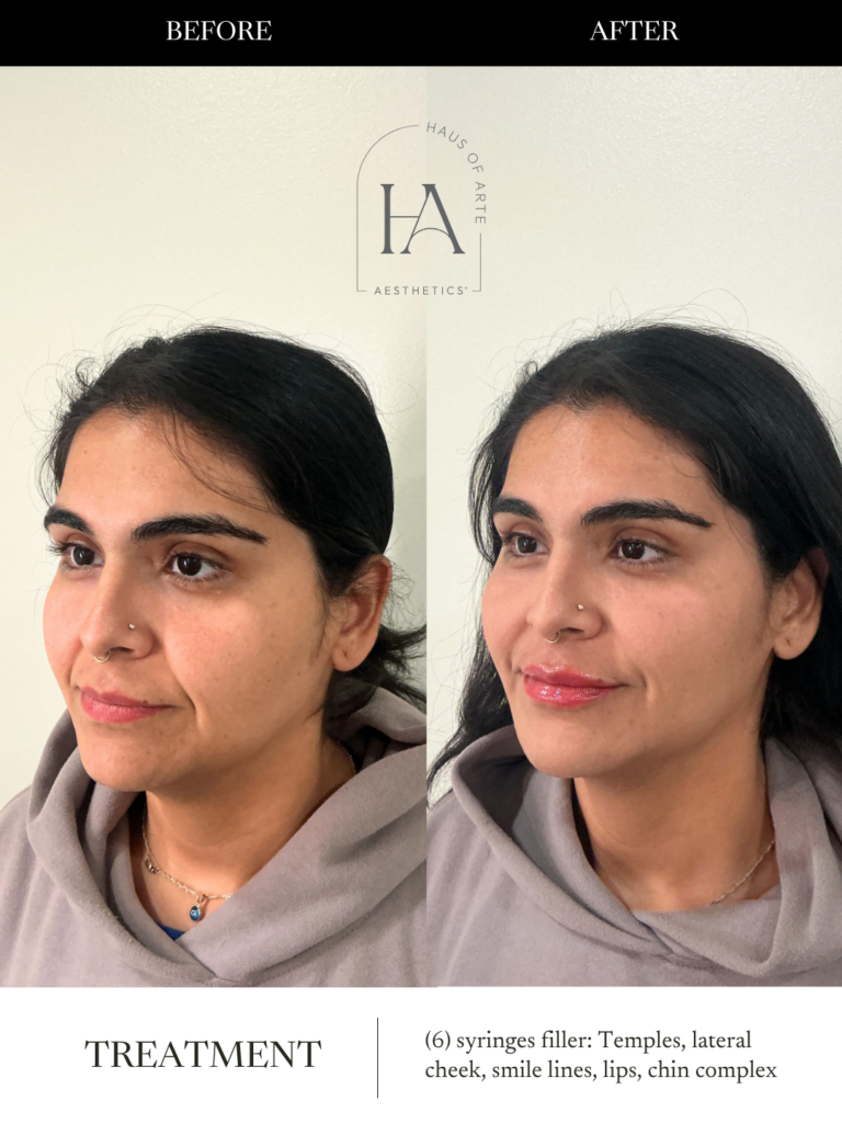 Before and After Image: 6 Syringes filler: Temples, lateral cheek, smile line, chin complex - left-front-oblique