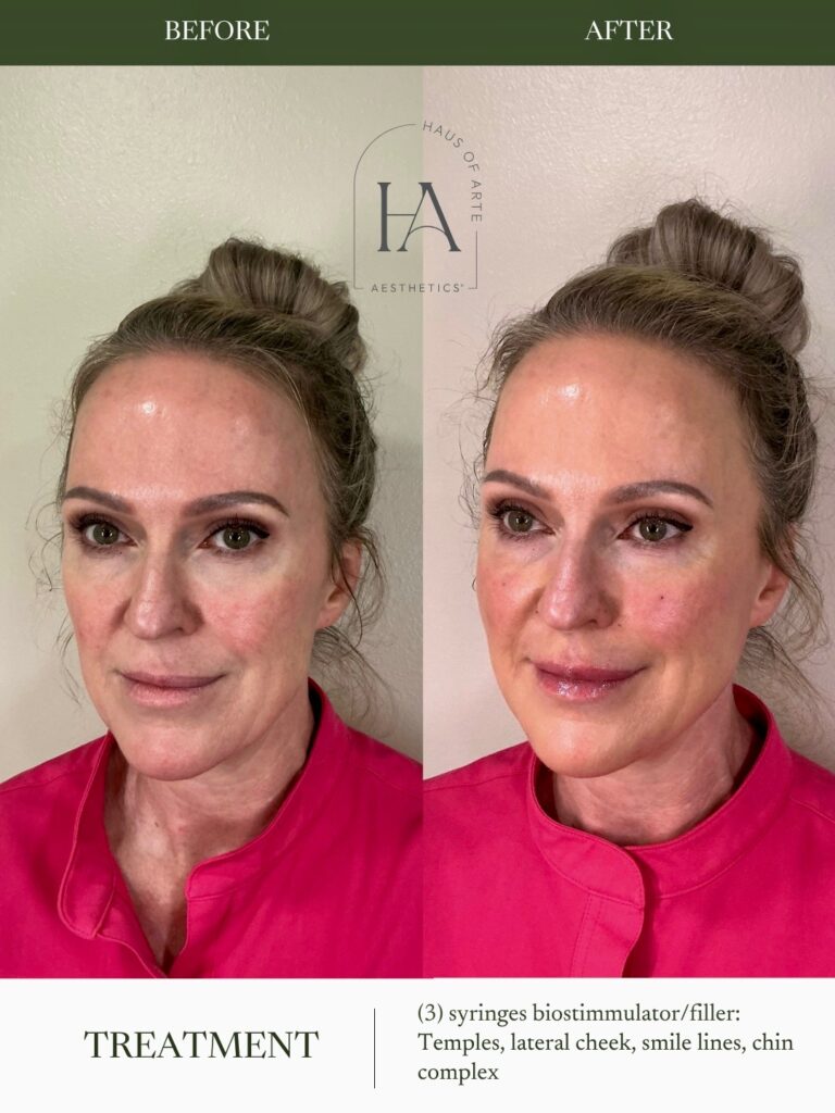 Before and After Image: 3 Syringes Biostimmulator/filler: Temples, lateral cheek, smile line, chin complex - left-front-oblique