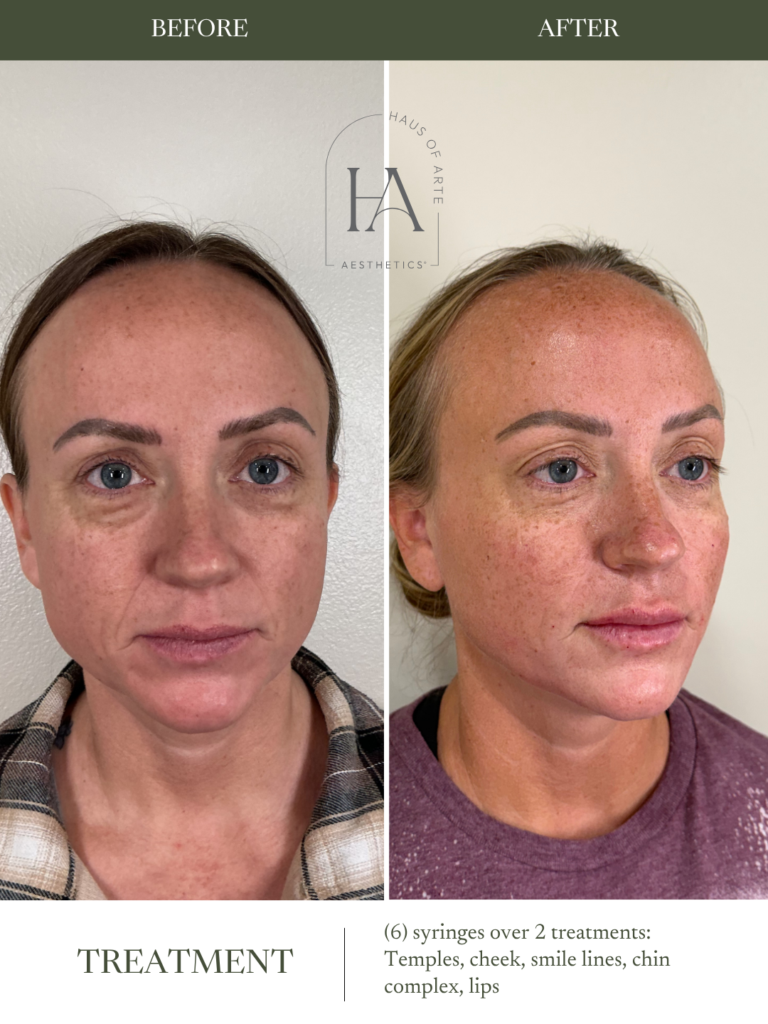 Before and After Image: 6 syringes over 2 treatments: Temples, cheek, smile lines, chin complex, lips - right-front-oblique