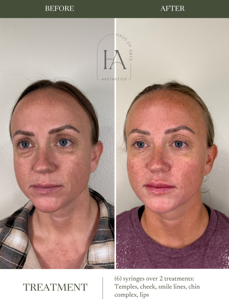 Before and After Image: 6 syringes over 2 treatments: Temples, cheek, smile lines, chin complex, lips - left-front-oblique