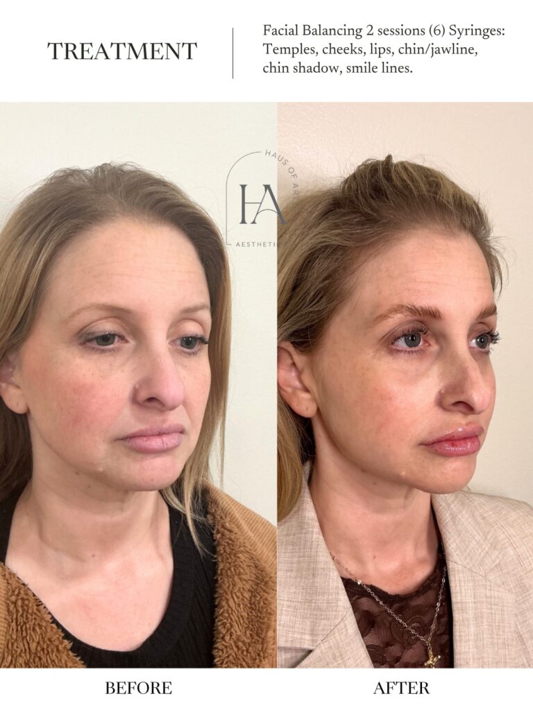 Before and After Image: Facial Balancing 2 Sessions - right-front-oblique