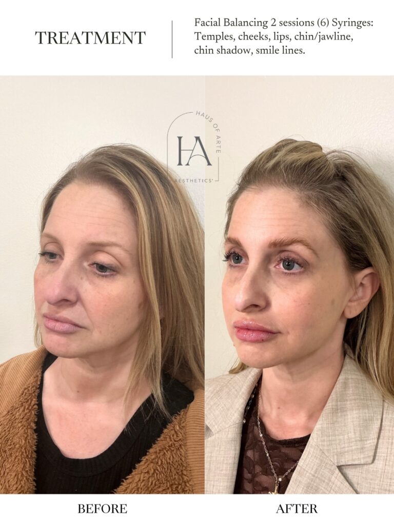 Before and After Image: Facial Balancing 2 Sessions - left-front-oblique