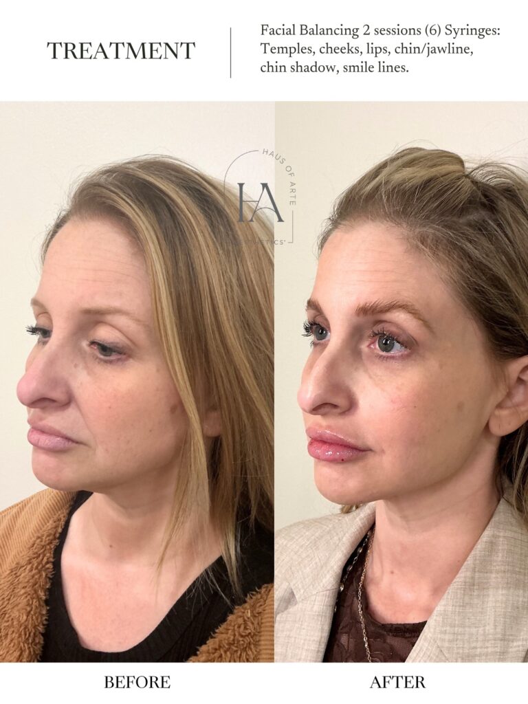 Before and After Image: Facial Balancing 2 Sessions - left-side