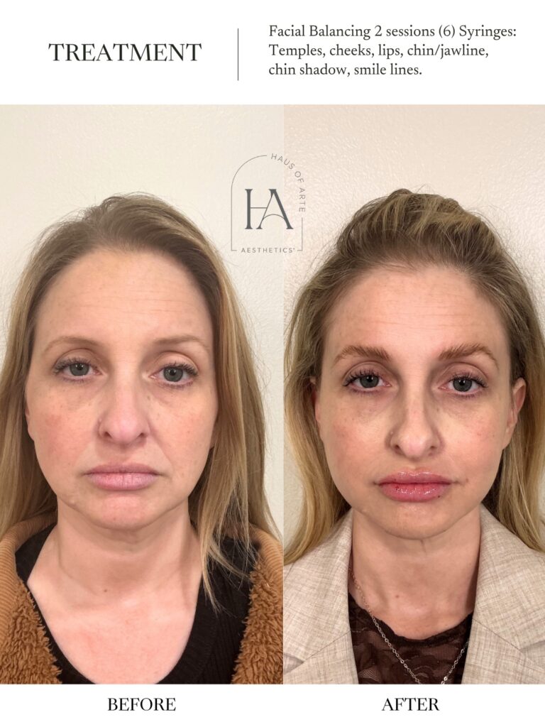 Before and After Image: Facial Balancing 2 Sessions - front
